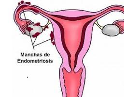 différence d'endométriose et d'adénomyose