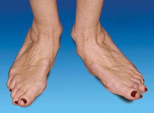 traitement des pieds pieds arthrite