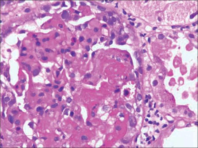 symptômes du syndrome phospholipidique 