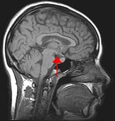 Hypothalamus et glande pituitaire