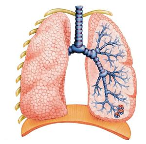 Maladie pulmonaire obstructive chronique - une menace pour la vie des consommateurs de tabac