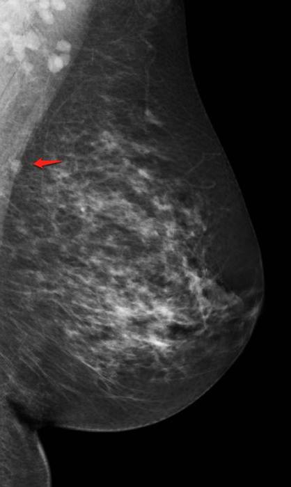 ganglion lymphatique intramammaire de la poitrine qu'il est 