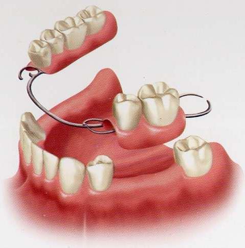 ce que les dentiers préfèrent mettre en revue