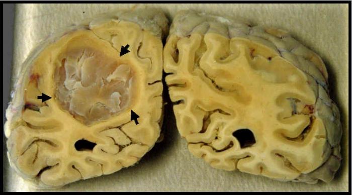 signes du cancer du cerveau