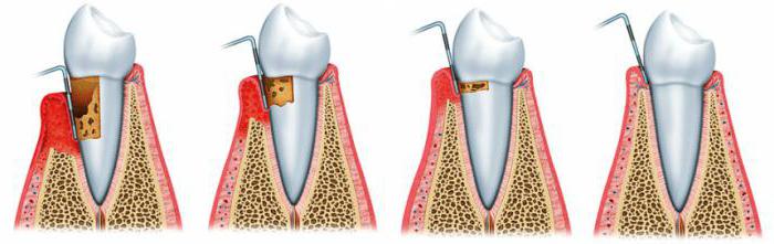 plasmolifting en technique de dentisterie