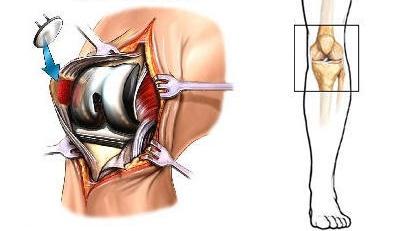 Prothèse de l'articulation du genou