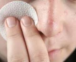 Les causes de l'acné sur le visage et comment se débarrasser d'eux