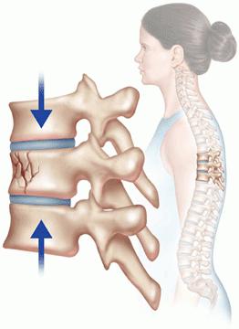 Causes, symptômes et traitement de la fracture par compression de la colonne vertébrale