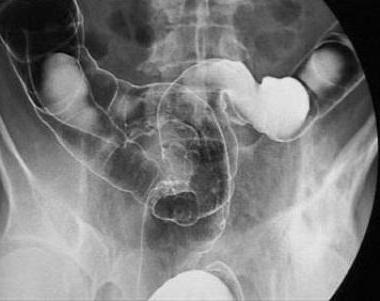 fonction du rectum humain en bref