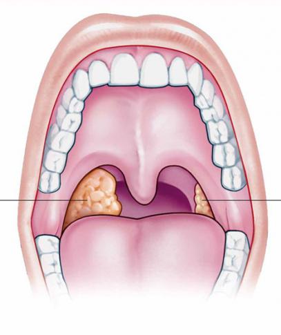 Bouchons amygdalites: traitement, causes et symptômes. Comment regardent les bouchons d'amygdalite (photo)